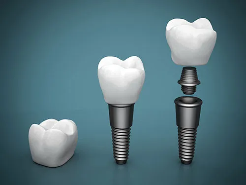 dental implant parts