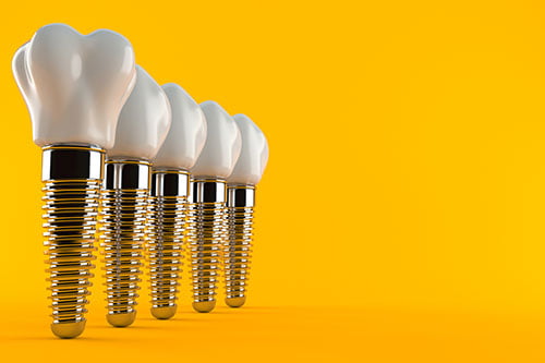 3D rendering of several dental implants